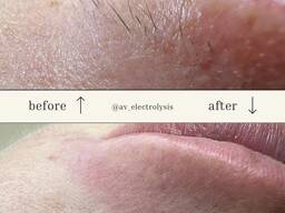 Electrolysis Dallas Электроэпиляция Даллас