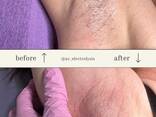 Electrolysis Dallas Электроэпиляция Даллас - photo 1